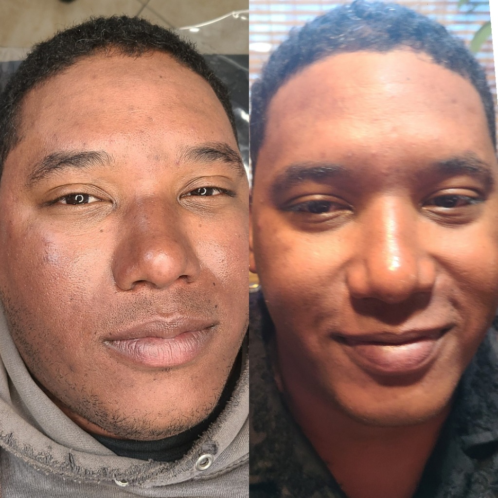 Male Brow Enhancement