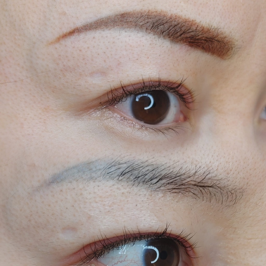 Nano Microblade Arch Correction