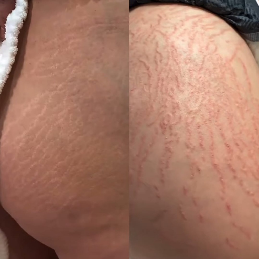 Inkless Stretch Mark Revision before and after comparison